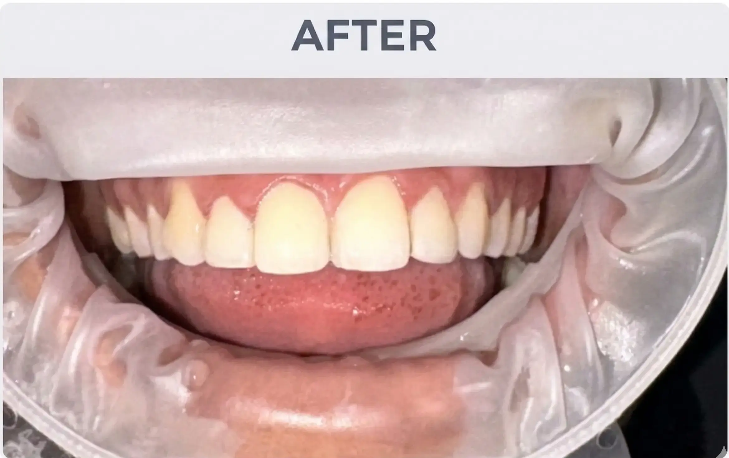 Smile Design After Treatment in Gandhinagar