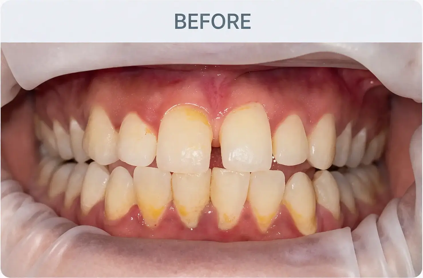 Smile Design Before Treatment in Gandhinagar