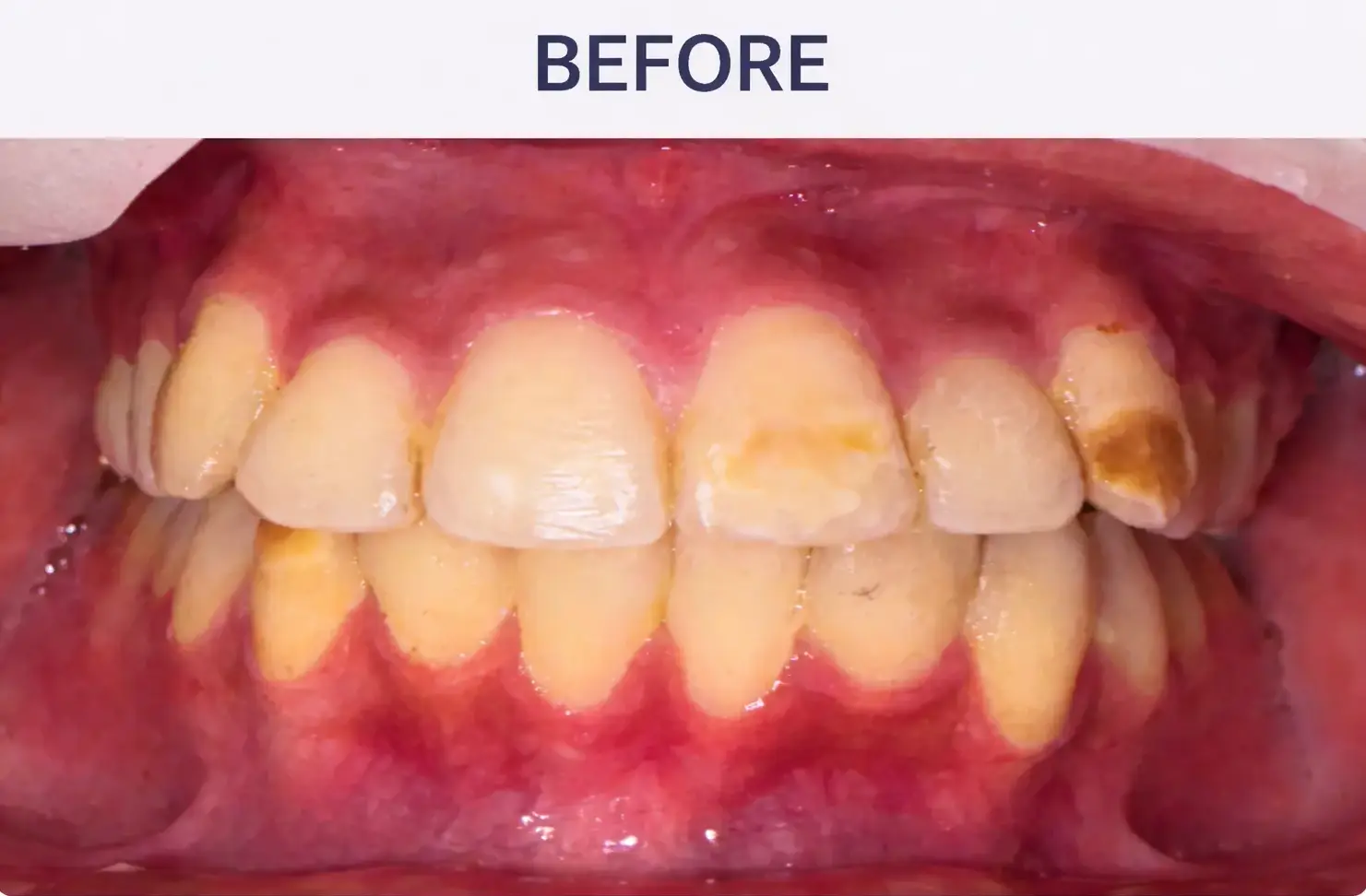 Advanced Aesthetic Restoration Before