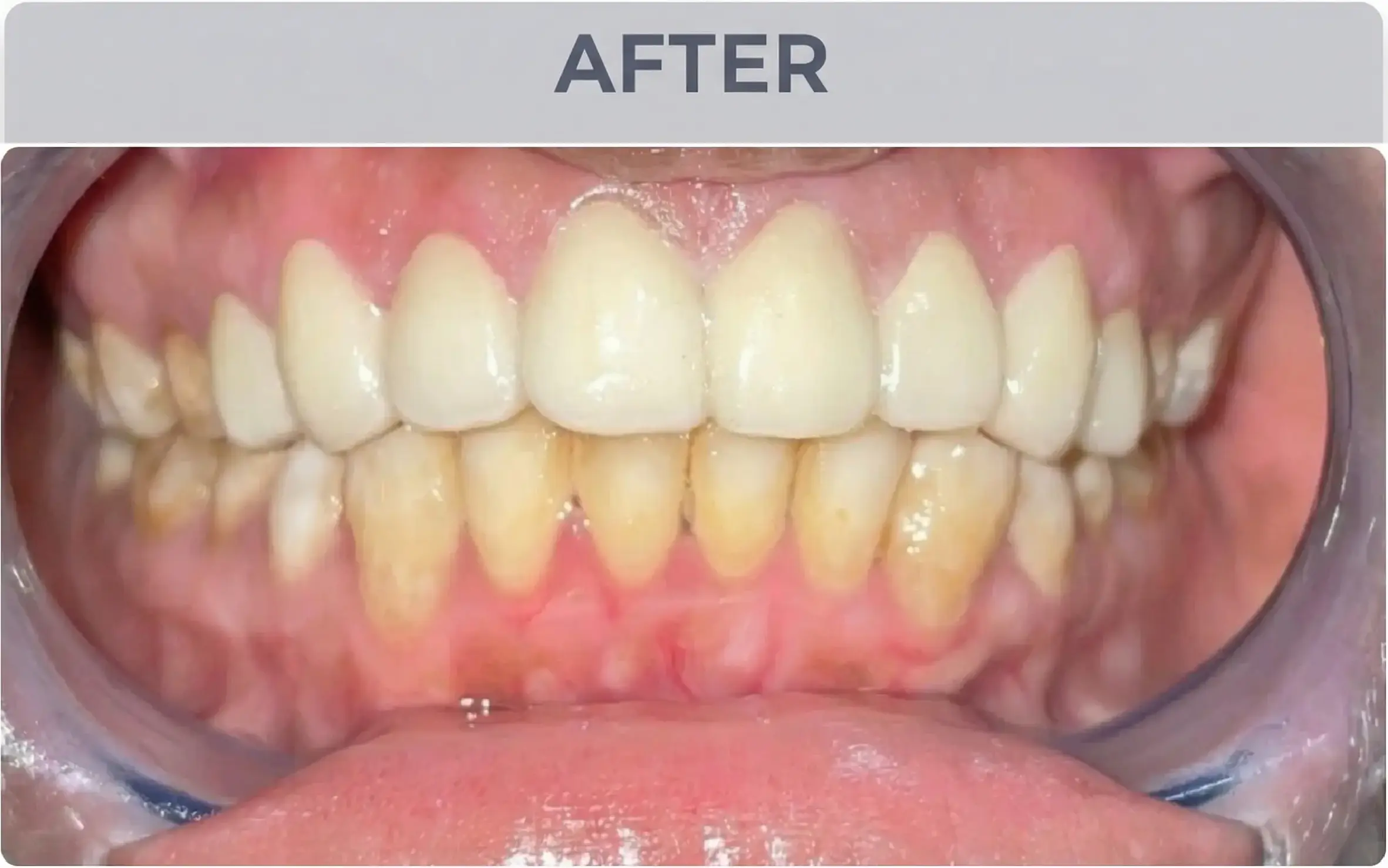 Diastema Closure After
