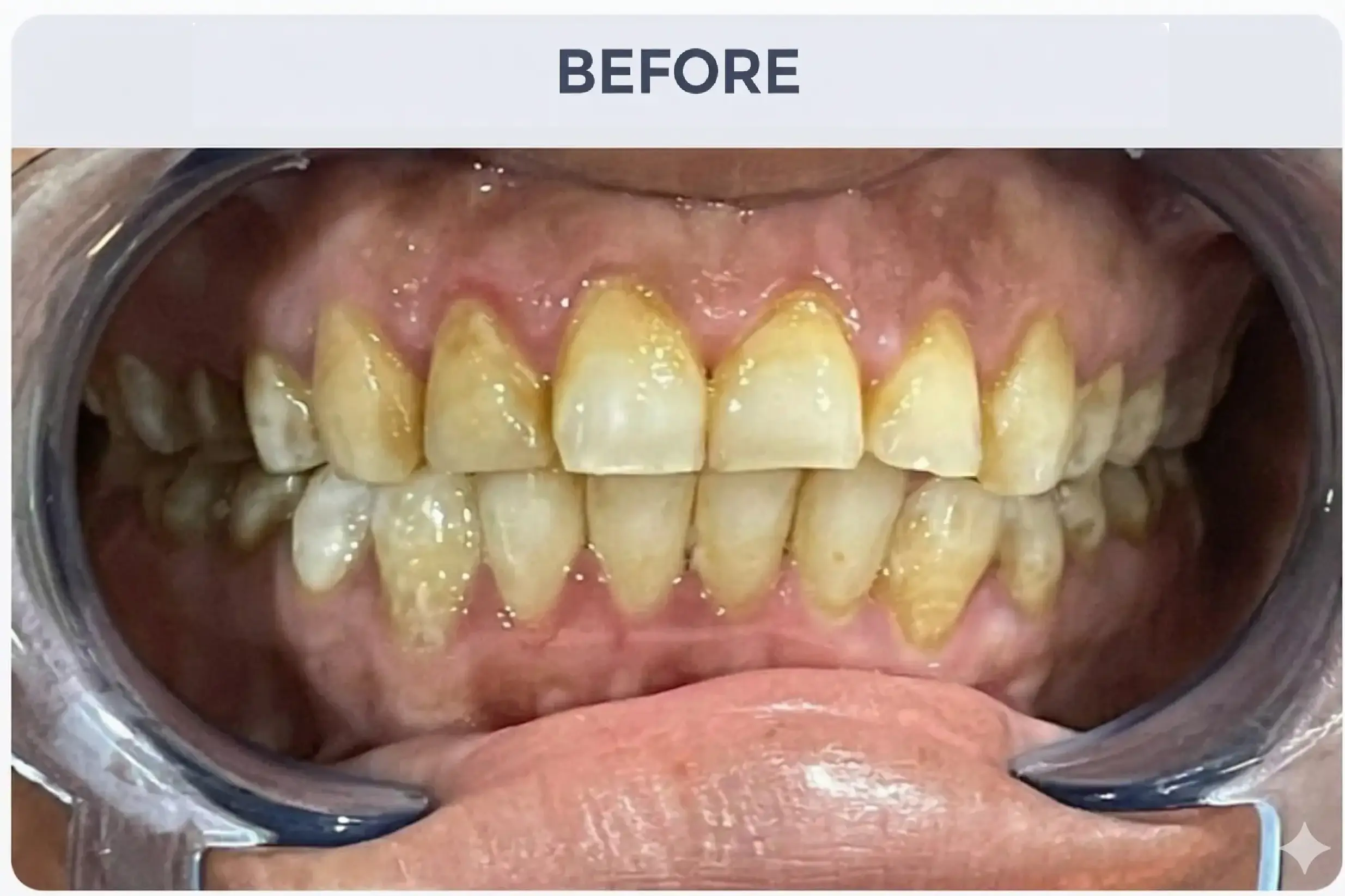 Diastema Closure Before