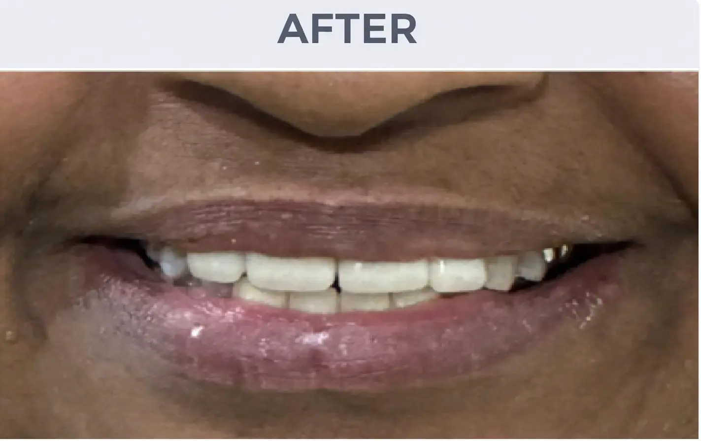 Composite Veneers After