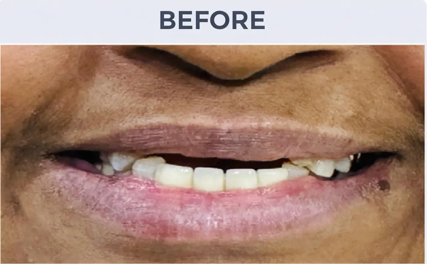 Composite Veneers Before