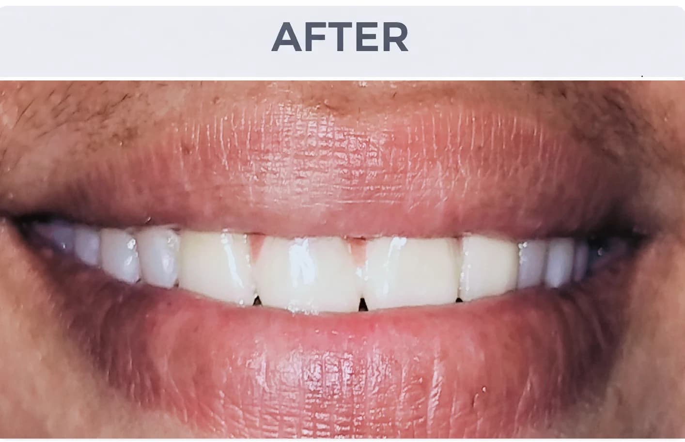 Complex Smile Makeover After