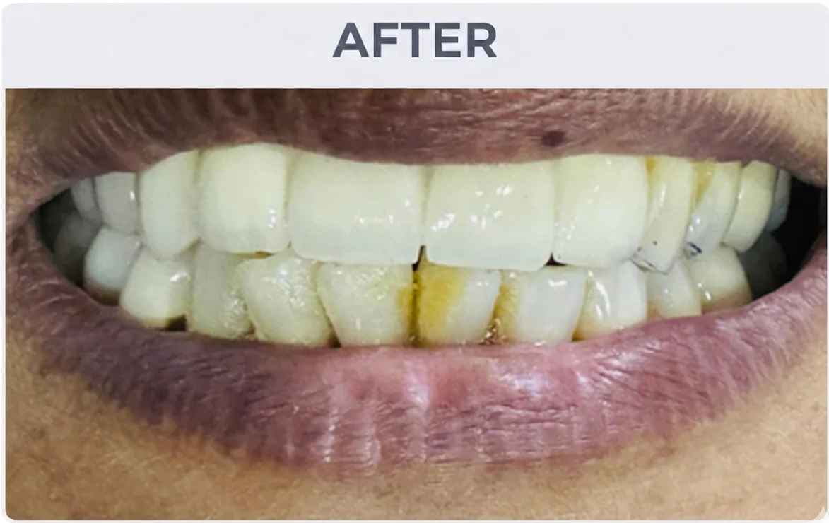 Ceramic Veneers After