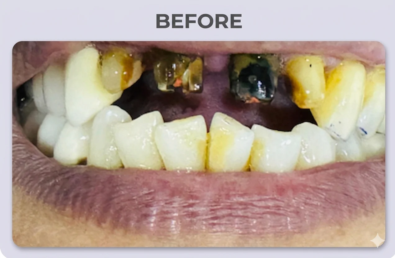 Ceramic Veneers Before